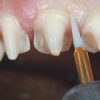NTI Boren en Frezen Tandheelkunde
